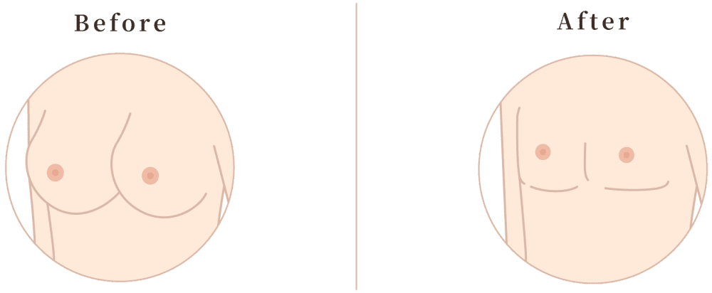 平胸手術 小知識 手術前後