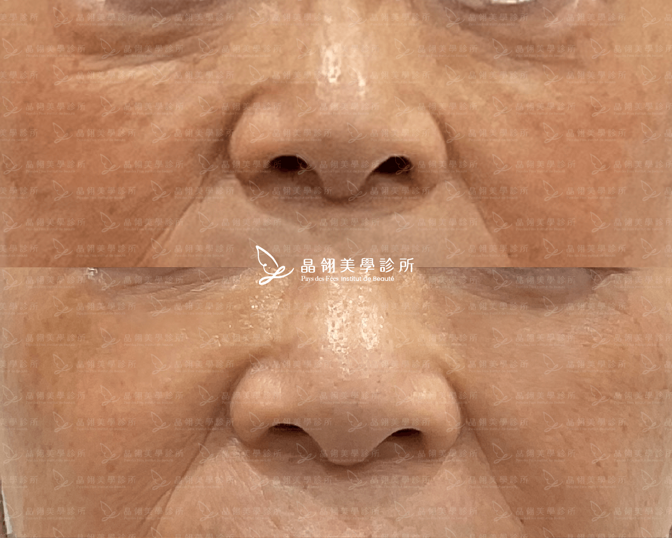 淚溝玻尿酸案例分享-朱女士(晶翎美學診所)