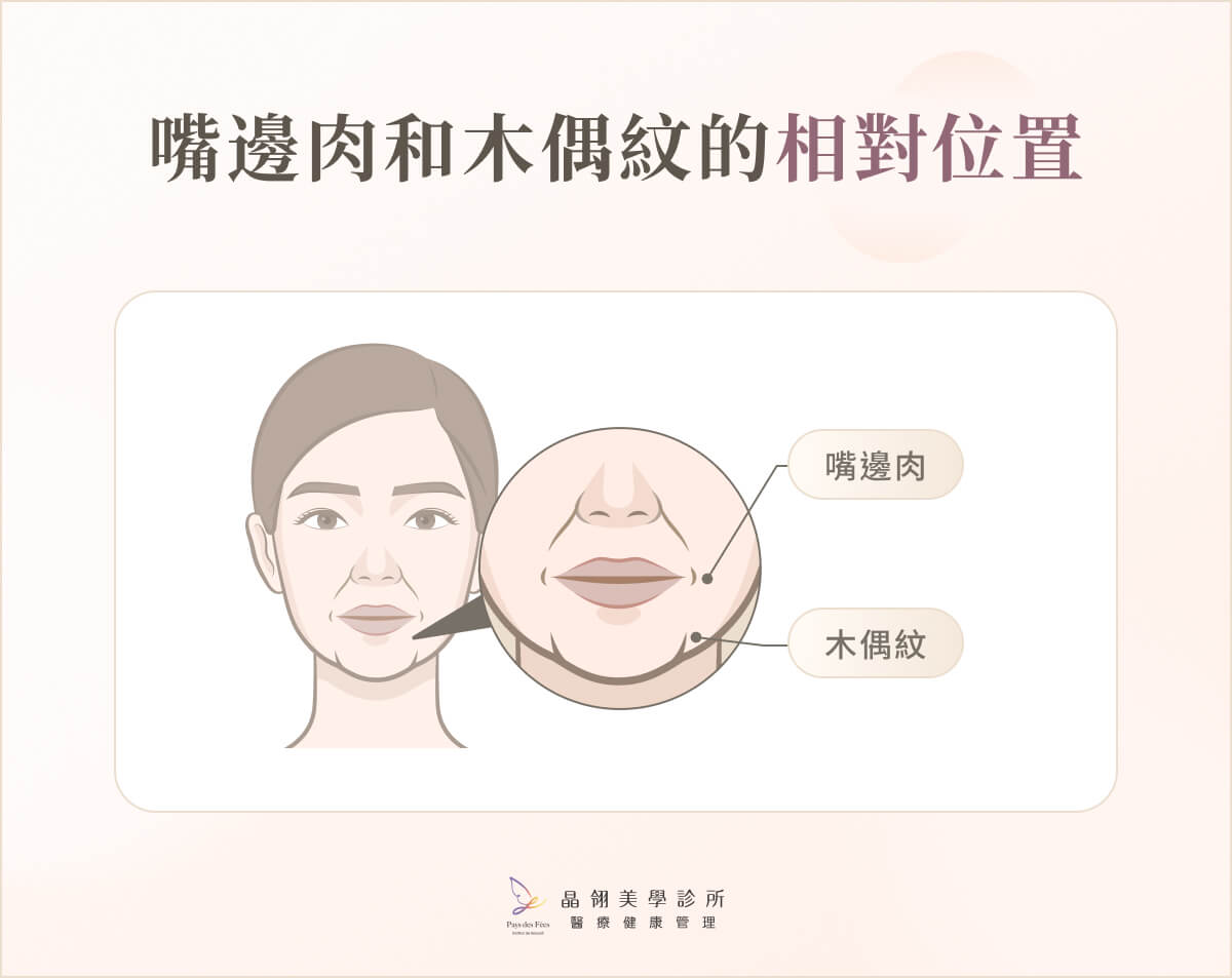 嘴邊肉和木偶紋的相對位置