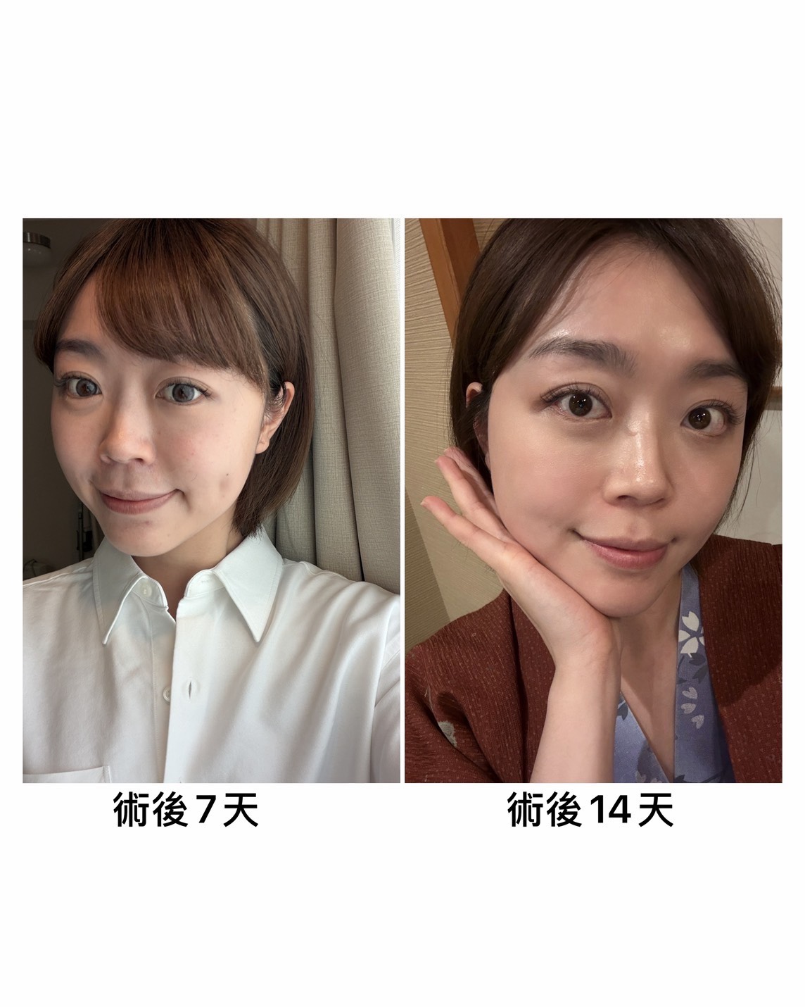 真實分享|雙機雷射打造無瑕素顏感,婚前膚況大逆轉!.jpg