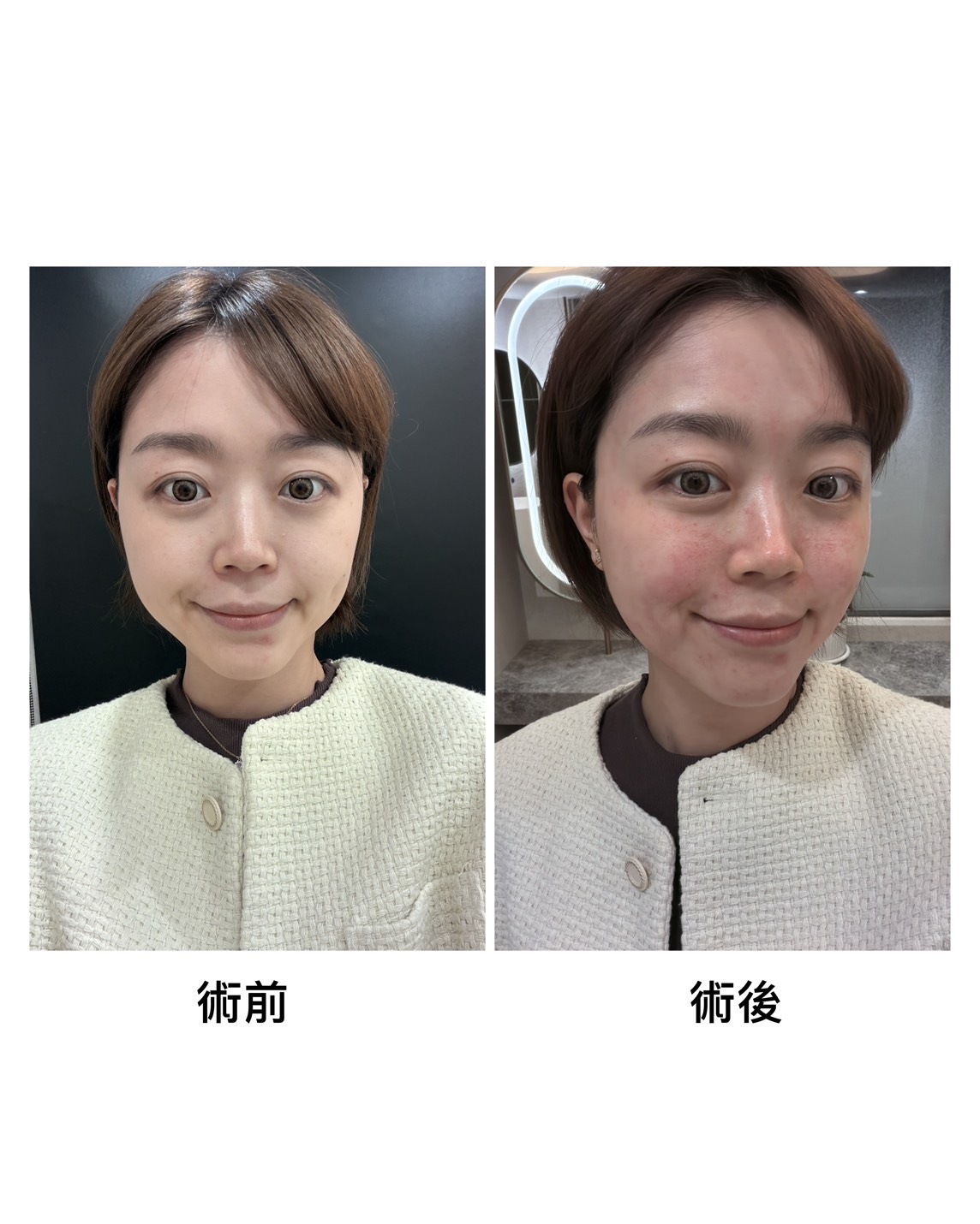 真實分享|雙機雷射打造無瑕素顏感,婚前膚況大逆轉!2.jpg