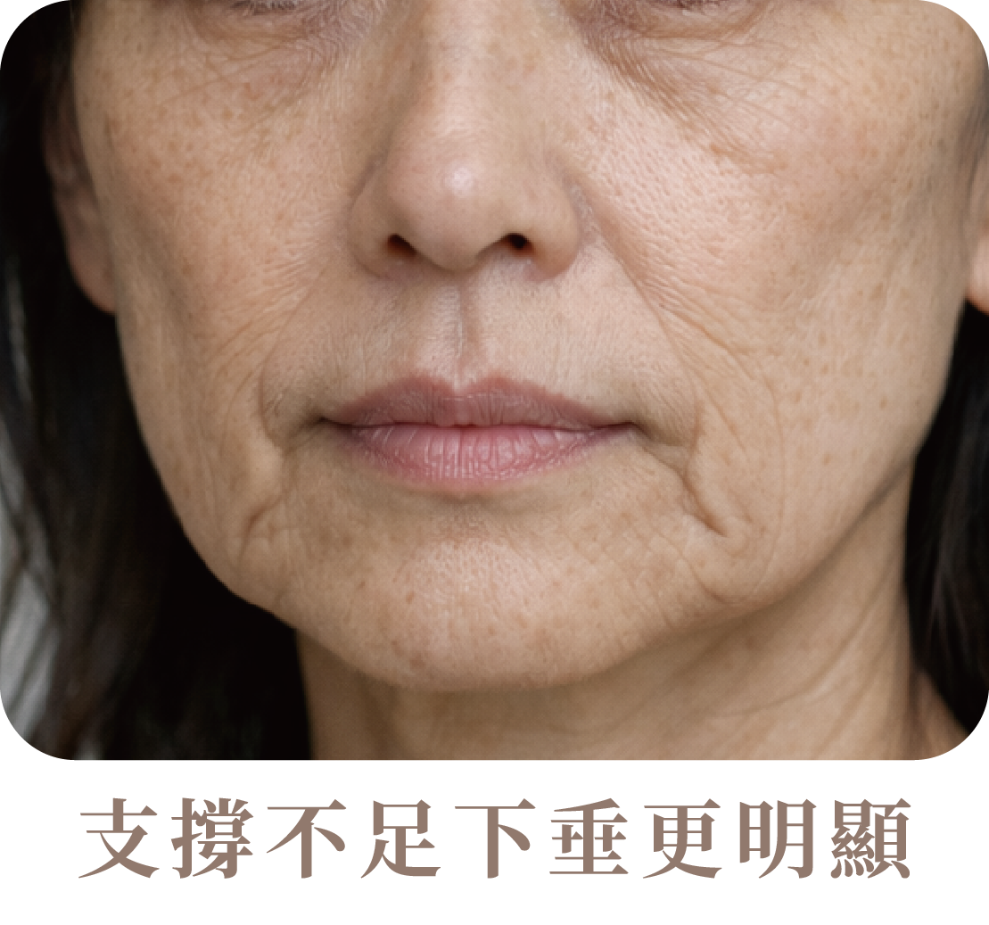猛健樂臉是什麼?臉凹、臉垮解析-10.png