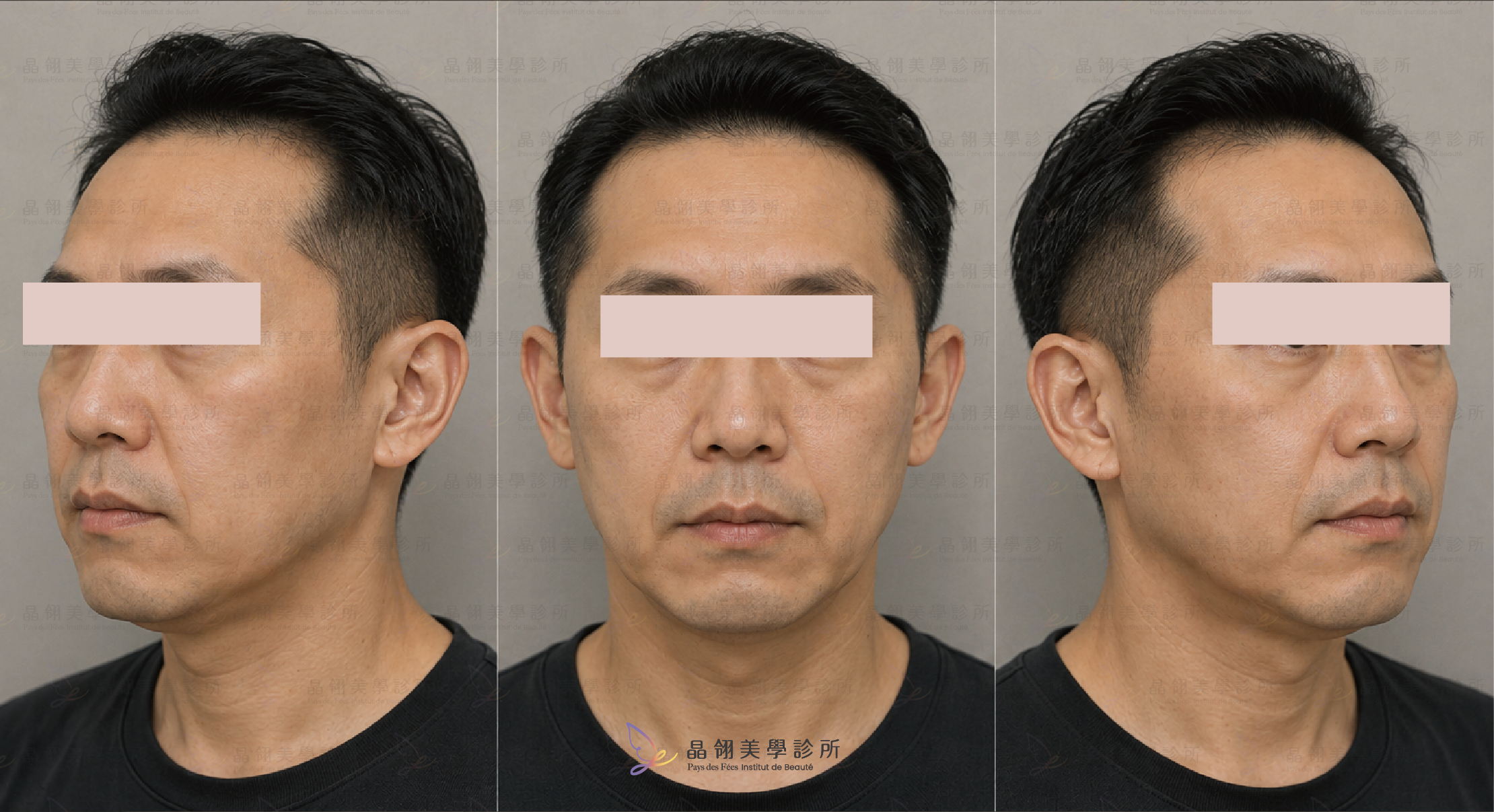 猛健樂臉是什麼?臉凹、臉垮解析-20.png