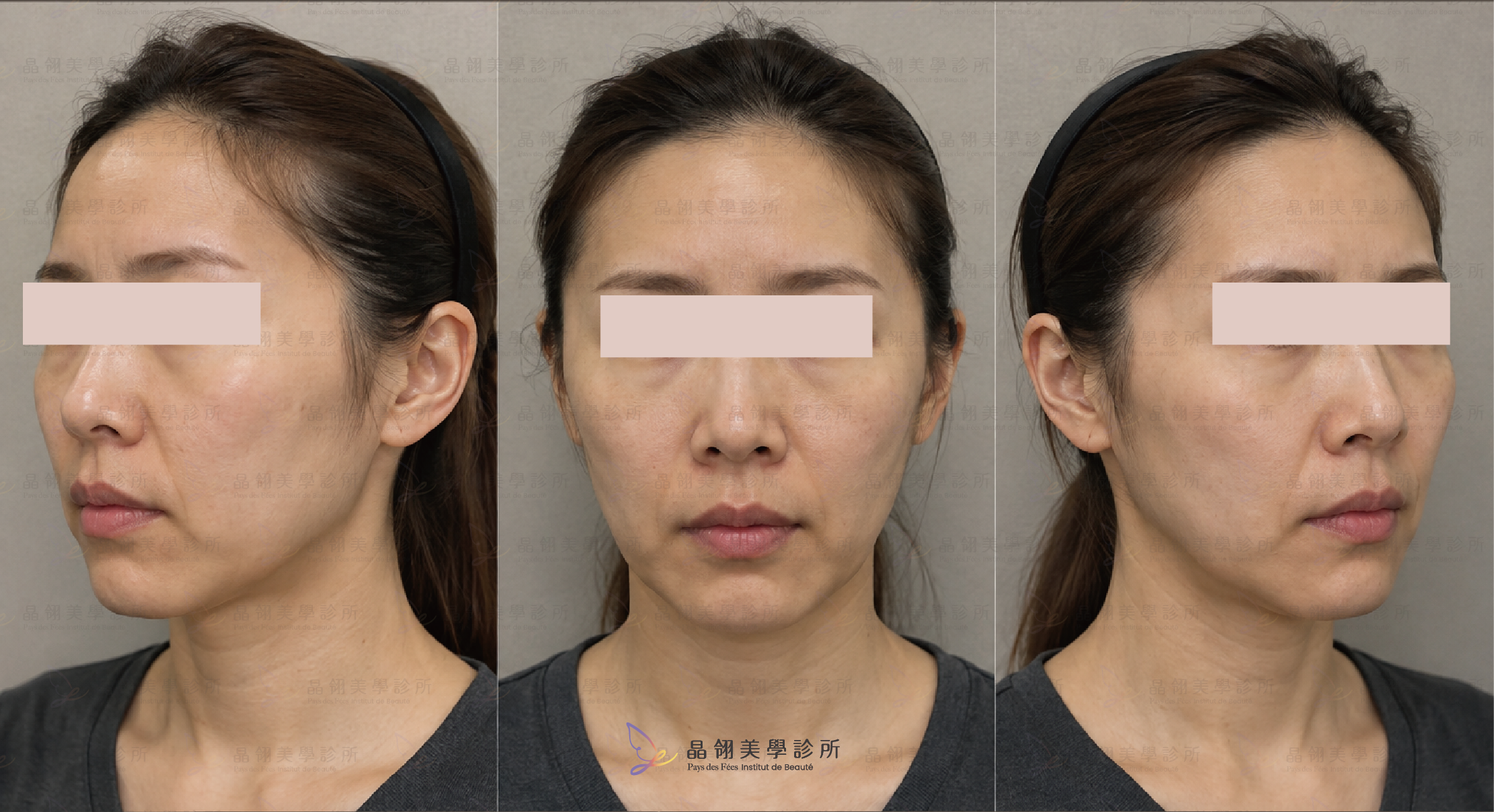 猛健樂臉是什麼?臉凹、臉垮解析-18.png