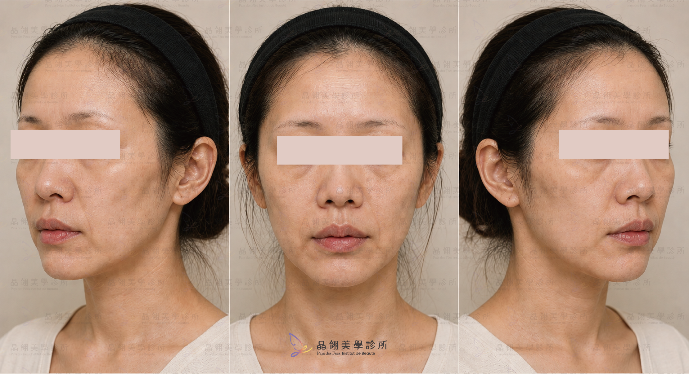 猛健樂臉是什麼?臉凹、臉垮解析-19.png